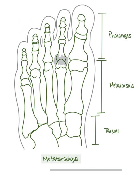 Forefoot Pain (Metatarsalgia) | The Rehab Centre